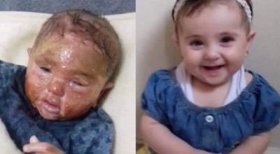 صورة الطفلة المصابة بحروق من الحسكة السورية وليست من تعز اليمنية